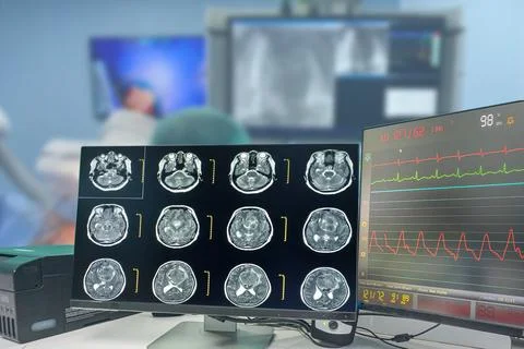 CT Scan brain Finding isodense mass with ill-defined margin and surrounding.. Stock Photos