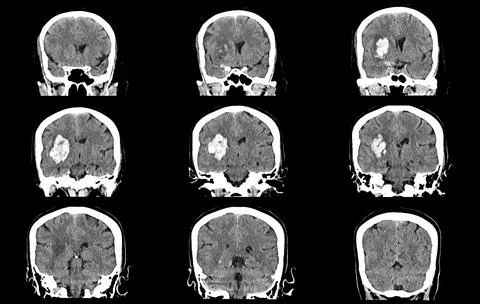 CT scan brain image showing intracerebral hemorrhage stroke Stock-Fotos