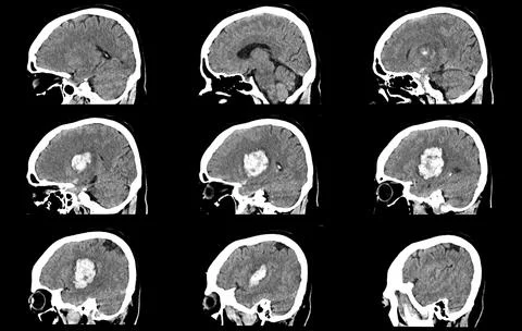 CT scan brain image showing intracerebral hemorrhage stroke Stockfoto's