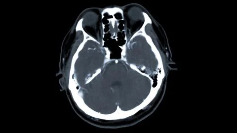CT scan of the brain with injection contrast media  for diagnosis brain tum.. Stock Illustration