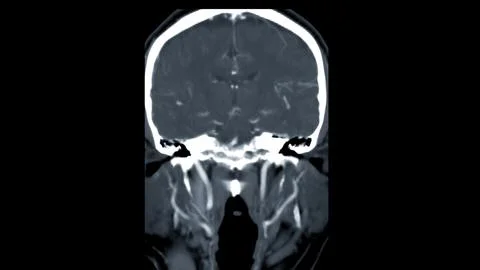 CT scan of the brain with injection contrast media  for diagnosis brain tum.. Stock Illustration