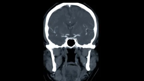 CT scan of the brain with injection contrast media  for diagnosis brain tum.. Stock Illustration
