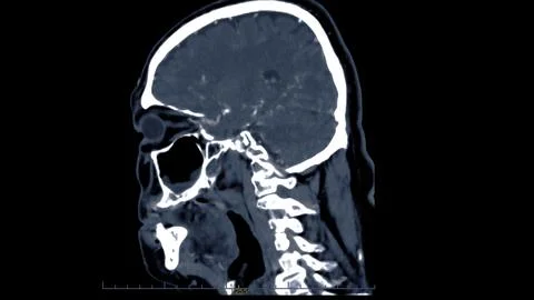 CT scan of the brain with injection contrast media  for diagnosis brain tum.. Stock-Illustration