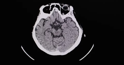 A CT scan of the brain of a patient with accident Stock Footage 160134581