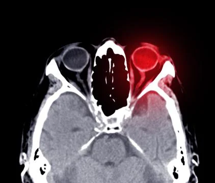 CT scan of the brain sagittal view  for diagnosis brain tumor,stroke diseases Stock Illustration