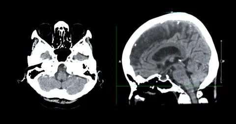 CT scan of the brain sagittal view  for diagnosis brain tumor,stroke diseas.. Stock Photos