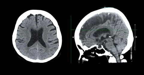 CT scan of the brain sagittal view  for diagnosis brain tumor,stroke diseas.. Stock Photos