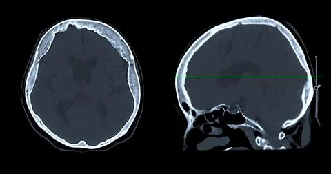 CT scan of the brain sagittal view  for diagnosis brain tumor,stroke diseas.. Stock Photos