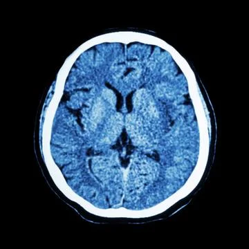 CT scan of brain : show normal human 's brain ( CAT scan ) Stock Photos