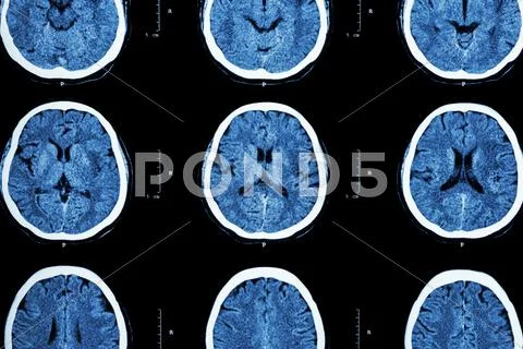 CT scan of brain show normal brain ( Neurological background ...