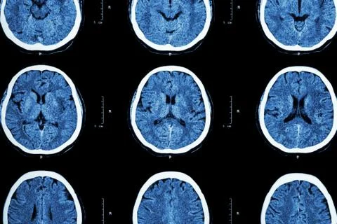 CT scan of brain show normal brain ( Neurological background ) Stock Photos
