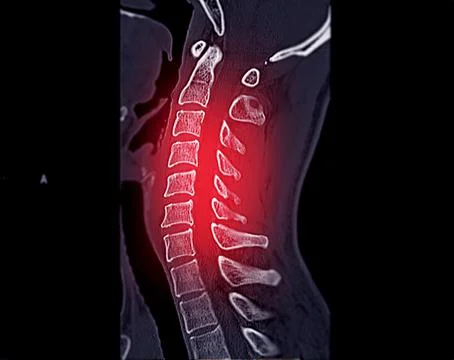 CT scan of C-Spine or Cervical spine Stock Illustration