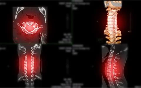 CT scan of C-Spine or Cervical spine Stock-Illustration