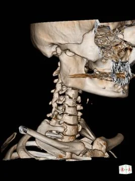 CT Scan cervical spine 3 D render . Stock Photos
