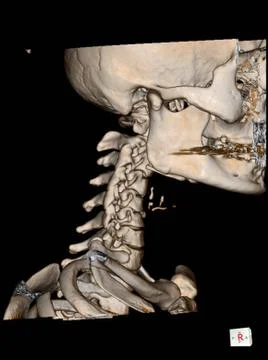 CT Scan cervical spine 3 D render . Stock Photos