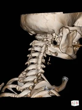 CT Scan cervical spine 3 D render . Stock Photos