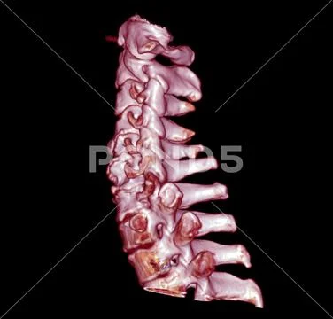 CT SCAN of Cervical Spine 3D rendering .: Royalty Free #208040190