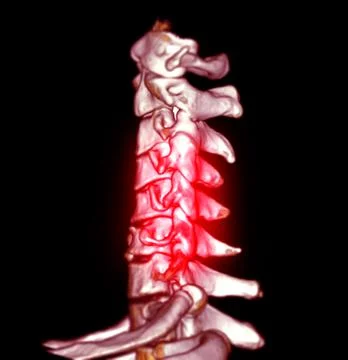 CT SCAN of Cervical Spine  3D rendering . Stock-Illustration