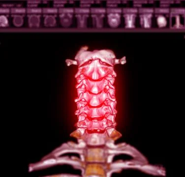 CT SCAN of Cervical Spine  3D rendering . Illustrazione stock