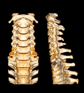 CT SCAN of Cervical Spine ( C-spine ) patient trauma case 3D rendering image  Stock Illustration