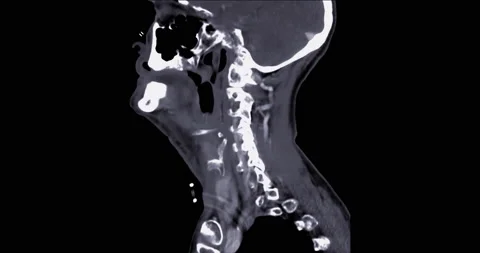 CT Scan of cervical spine . Stock Footage 203738184