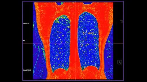 CT scan of Chest coronal view in color mode  for diagnostic Pulmonary embol.. Stock-Illustration