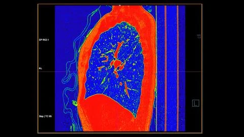CT scan of Chest coronal view in color mode  for diagnostic Pulmonary embol.. Stock Illustration