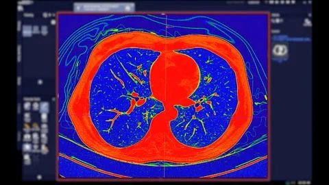 CT scan of Chest coronal view in color mode  for diagnostic Pulmonary embol.. Stock Illustration