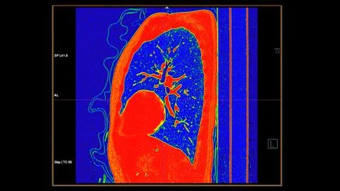 CT scan of Chest coronal view in color mode  for diagnostic Pulmonary embol.. Stock Illustration