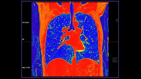 CT scan of Chest coronal view in color mode  for diagnostic Pulmonary embol.. Stock Illustration