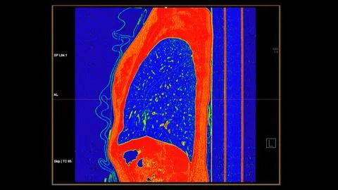 CT scan of Chest coronal view in color mode  for diagnostic Pulmonary embol.. Stock Illustration