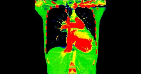 CT scan of Chest coronal view in color mode  for diagnostic Pulmonary embol.. Stock Illustration