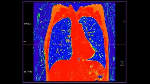 CT scan of Chest coronal view in color mode  for diagnostic Pulmonary embol.. Illustrazione stock