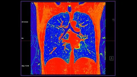 CT scan of Chest coronal view in color mode  for diagnostic Pulmonary embol.. Stock Illustration