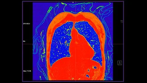 CT scan of Chest coronal view in color mode  for diagnostic Pulmonary embol.. 스톡 일러스트