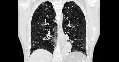 CT scan of Chest coronal view for diagnostic Pulmonary embolism (PE) , lung.. Stock Photos