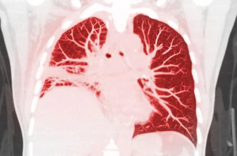 CT scan of Chest or lung coronal mip view of lung infection covid-19 with gro Stock Illustration