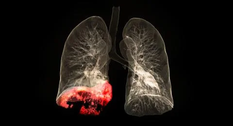 CT scan of Chest or lung 3d rendering image showing lung infection covid-19 a Stock Illustration