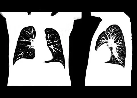 CT scan of Chest or lung  at radiology department in hospital. Covid-19 scan  Stock-Illustration