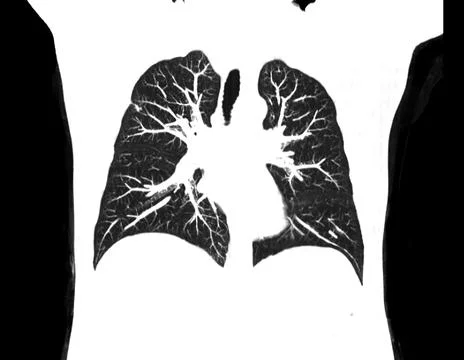 CT scan of Chest or lung  at radiology department in hospital. Covid-19 scan  Stock Illustration