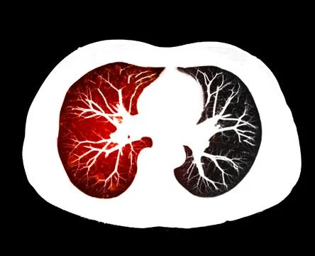CT scan of Chest or lung  at radiology department in hospital. Covid-19 scan  Stock Illustration