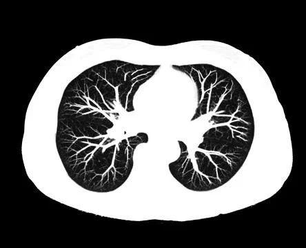 CT scan of Chest or lung  at radiology department in hospital. Covid-19 scan  Stock-Illustration