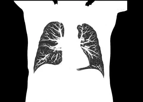CT scan of Chest or lung  at radiology department in hospital. Covid-19 scan  Stock-Illustration