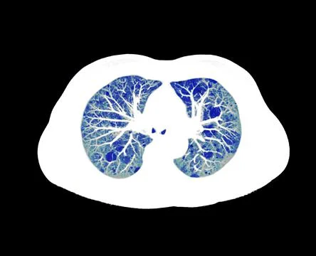 CT scan of Chest or lung  at radiology department in hospital. Covid-19 scan  Illustrazione stock