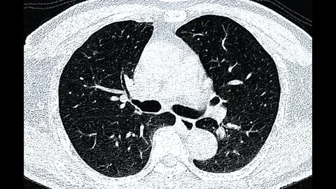 CT scan of Chest or lung  axial view for screening lung nodules and lung canc Stock Illustration