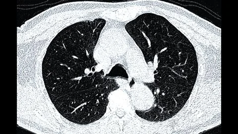 CT scan of Chest or lung  axial view for screening lung nodules and lung canc Illustrazione stock