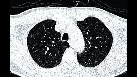 CT scan of Chest or lung  axial view for screening lung nodules and lung canc Stock Illustration