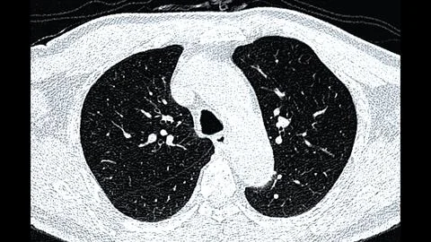 CT scan of Chest or lung  axial view for screening lung nodules and lung canc Stock Illustration