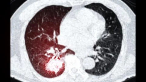 CT scan of Chest or lung  axial viewshowing lung cancer lung cancer . Stock Illustration