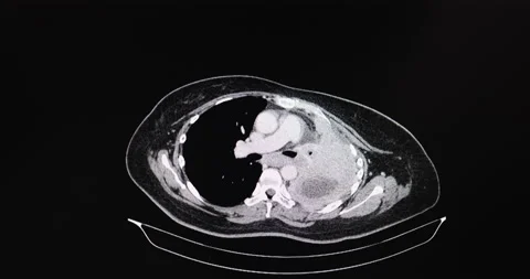 CT scan of a chest of a patient with lung cancer Stock Footage 160434489